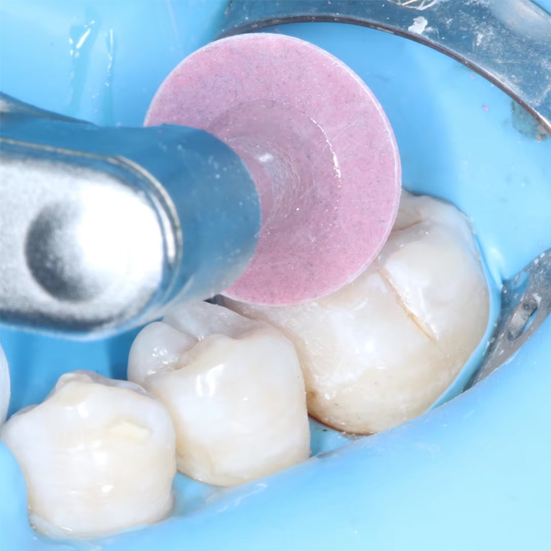 40 disques de polissage dentai - Teeth Whitening Kit Professional avis et prix
