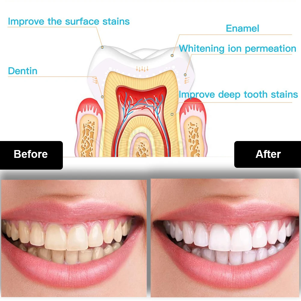 Kit de blanchiment des dents d - Teeth Whitening Kit With Light avis et prix